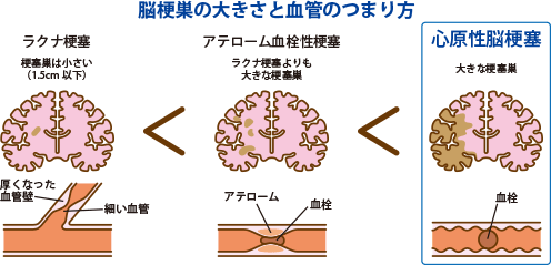 脳梗巣の大きさと血管のつまり方